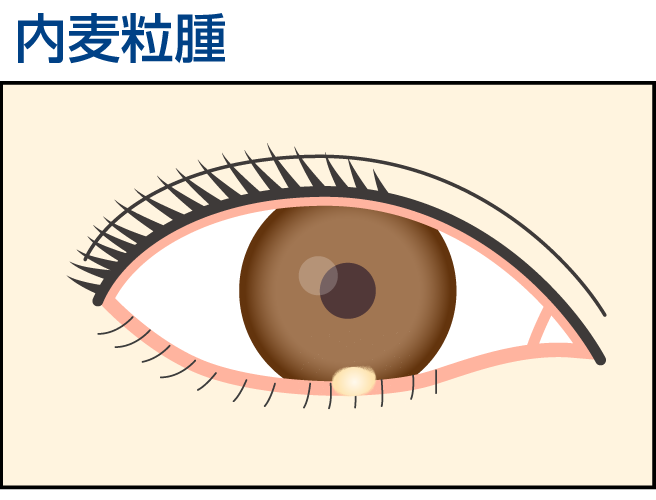 内麦粒腫